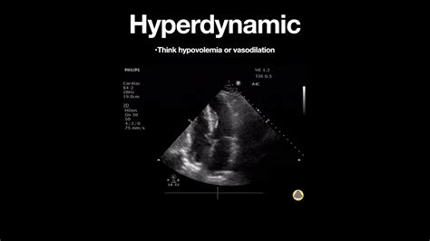 is hyperdynamic left ventricle dangerous.